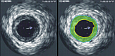 Сужение артерии на ультразвуковой диагностике. Зеленым цветом отмечена зона бляшки. Источник: Ksheka